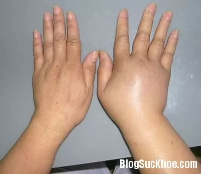 Những nguyên nhân bệnh gây triệu chứng phù