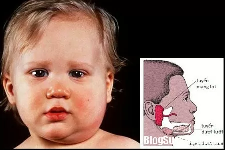Biến chứng nguy hiểm của bệnh quai bị