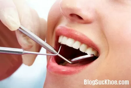 Lợi ích khi lấy cao răng định kỳ