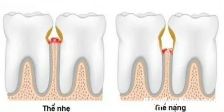 Biến chứng nguy hiểm khi bị viêm lợi