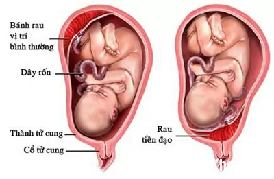 Chẩn đoán rau tiền đạo