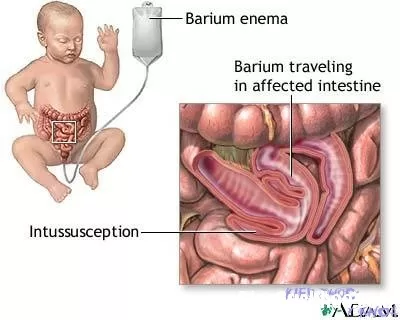 Nguyên nhân gây lồng ruột ở trẻ em