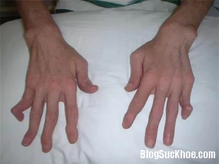 Dấu hiệu và cách chữa bệnh viêm gan tự miễn