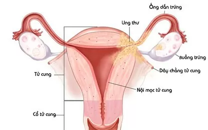 Những điều chị em cần lưu ý khi cắt bỏ tử cung