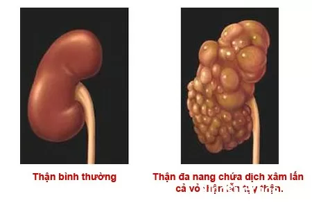Bệnh thận đa nang