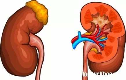 Những điều cần biết về bệnh suy thận cấp