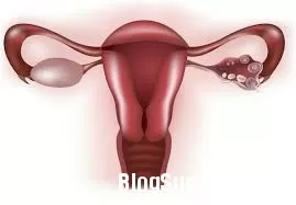 Điều trị bệnh suy buồng trứng sớm
