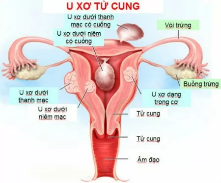 Nguyên nhân và triệu chứng bệnh u xơ tử cung