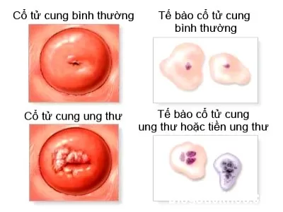 Các triệu chứng ung thư cổ tử cung