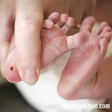 Trẻ có thể bị bại não nếu không phát hiện sớm bệnh thiếu G6PD
