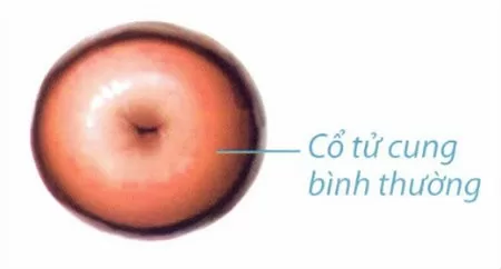 5 bệnh thường gặp về cổ tử cung