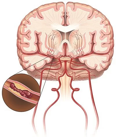 Đột quỵ có phải là cơ đau tim?