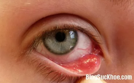 Một số điều cần biết về bệnh đau mắt đỏ