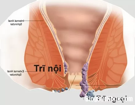 Phương pháp chữa bệnh trĩ ngoại