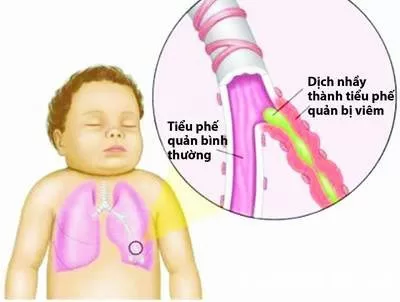 Dấu hiệu trẻ bị viêm tiểu phế quản
