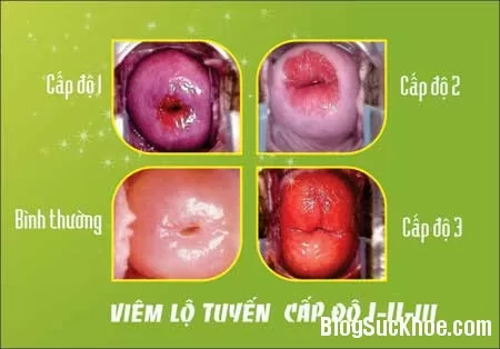 Biểu hiện và cách điều trị viêm lộ tuyến cổ tử cung