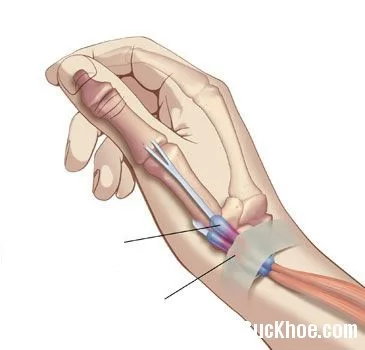 Bệnh viêm phần mềm quanh khớp