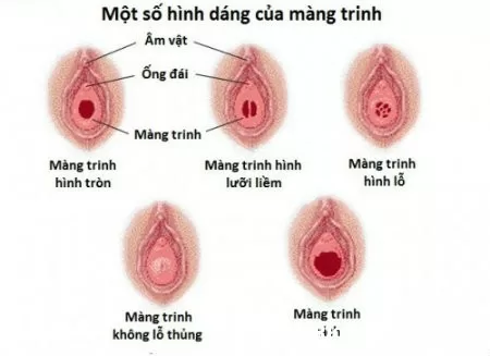 Một số loại và hình dáng của màng trinh