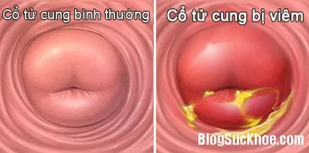 Phân biệt các bệnh viêm tử cung, viêm cơ tử cung, viêm âm đạo