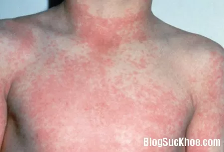 Cách điều trị bệnh ban đỏ