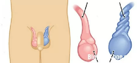 Hội chứng bìu cấp