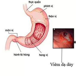 Dấu hiệu nhận biết và cách phòng ngừa bệnh dạ dày