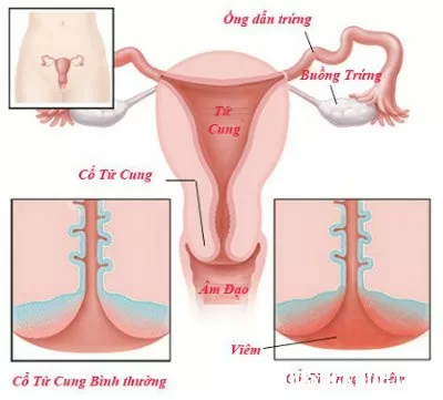 Phương pháp giảm đau bụng kinh hiệu quả