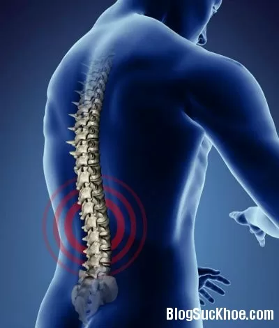 Dấu hiệu và cách điều trị bệnh gai cột sống