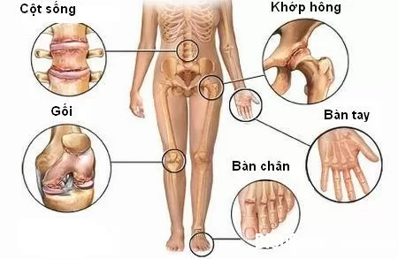 Dấu hiệu bệnh thoái hóa khớp