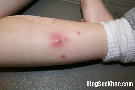 Mụn nhọt có thể gây ra biến chứng viêm tim