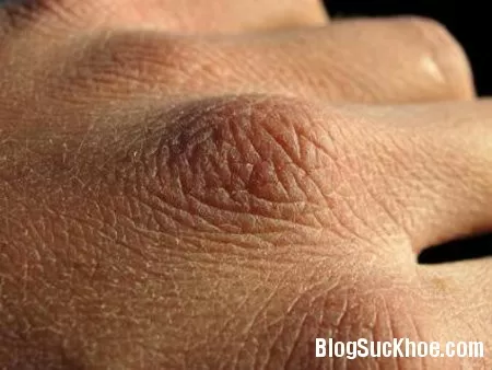 Điều trị ngứa da ở người cao tuổi