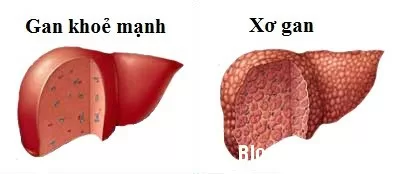 Điều trị bệnh xơ gan theo đông y