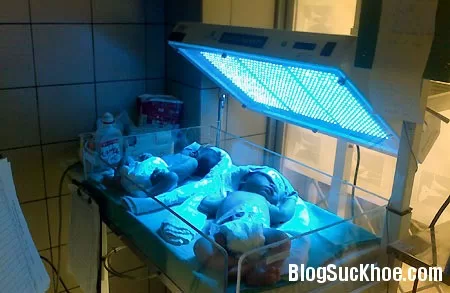 Vàng da ở bé sơ sinh non tháng