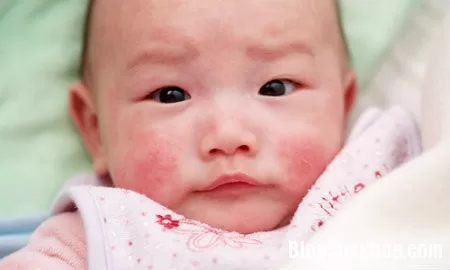 Chăm sóc bé bị viêm da cơ địa
