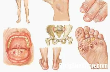 Những bệnh do nhiễm Chlamydia gây nên