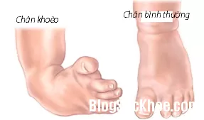 Khoèo chân ở trẻ sơ sinh