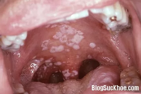 Triệu chứng bệnh lậu ở nam giới