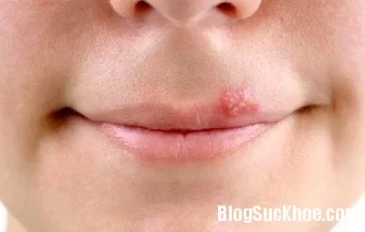 Triệu chứng và phương pháp phòng bệnh mụn rộp sinh dục