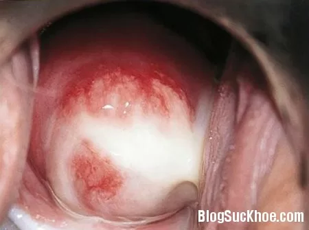 Cách phòng tránh bệnh Chlamydia