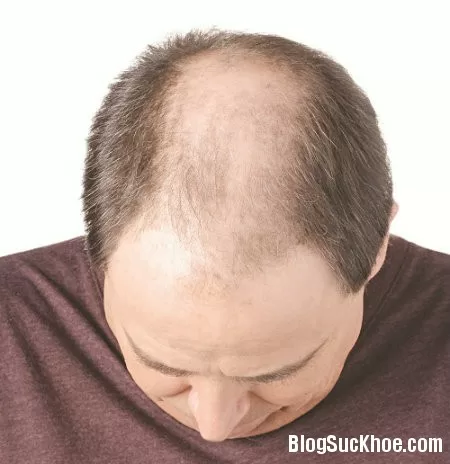 Những dấu hiệu cảnh báo bệnh động mạch vành