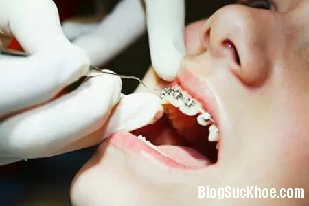 Chăm sóc răng niềng đúng cách