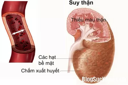 6 triệu chứng suy thận chị em nên lưu ý