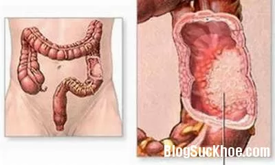Bệnh tiêu chảy phân mỡ là gì?