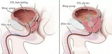 Chứng tiểu đêm ở người cao tuổi
