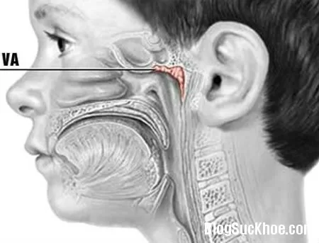 Nhận biết khi trẻ bị viêm V.A