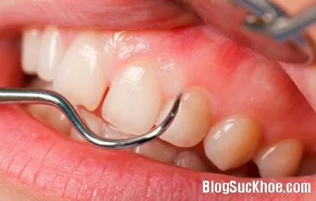 Những điều cần biết về bệnh viêm lợi