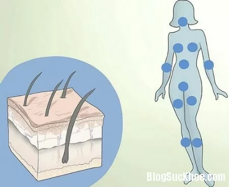 Dấu hiệu nhận biết hội chứng buồng trứng đa nang