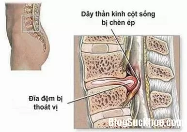 Đau thần kinh tọa và phương pháp điều trị