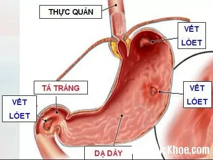 Triệu chứng nhận biết bệnh viêm loét dạ dày
