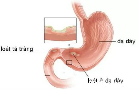 Cách nhận biết viêm dạ dày cấp tính